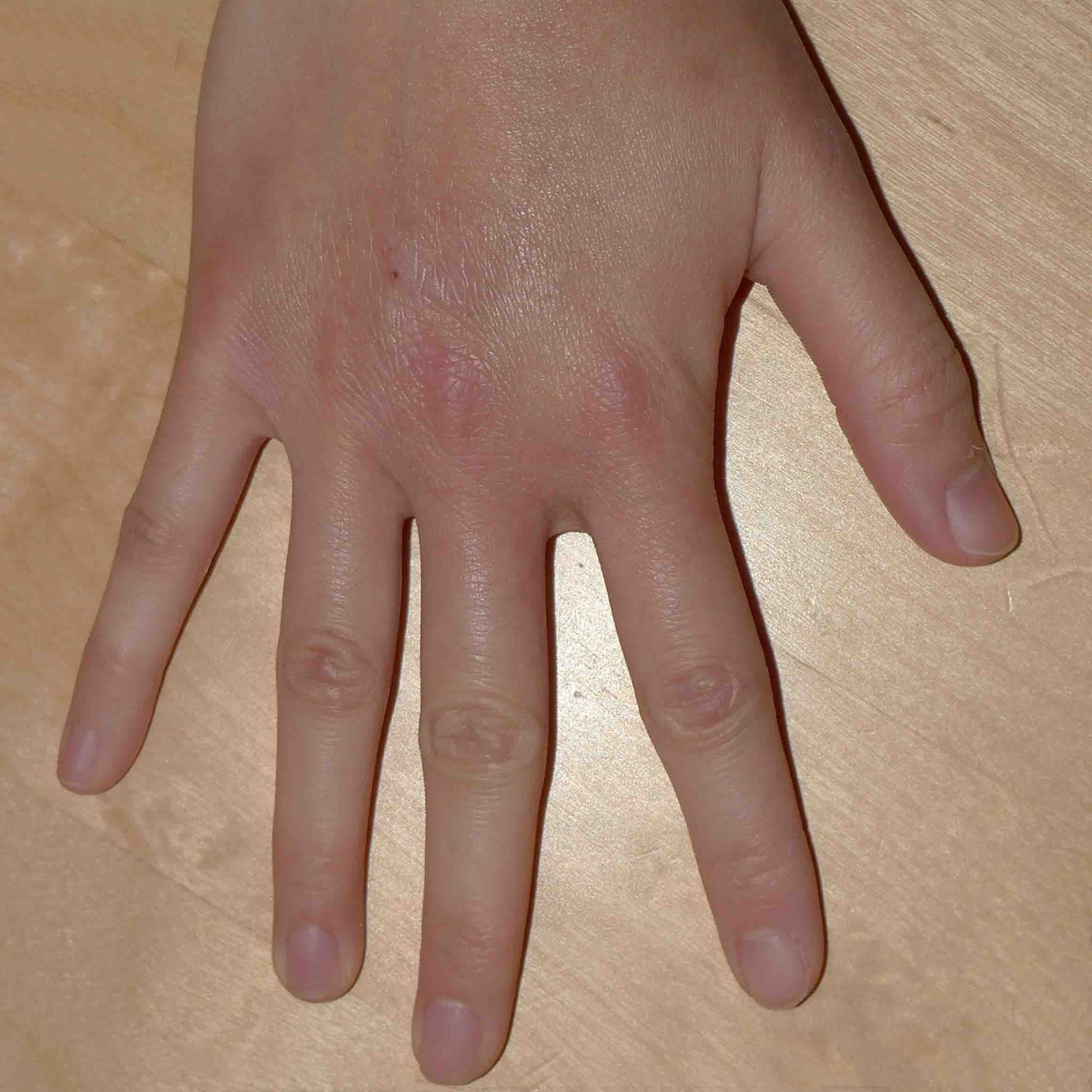 Rubi's Eczema After